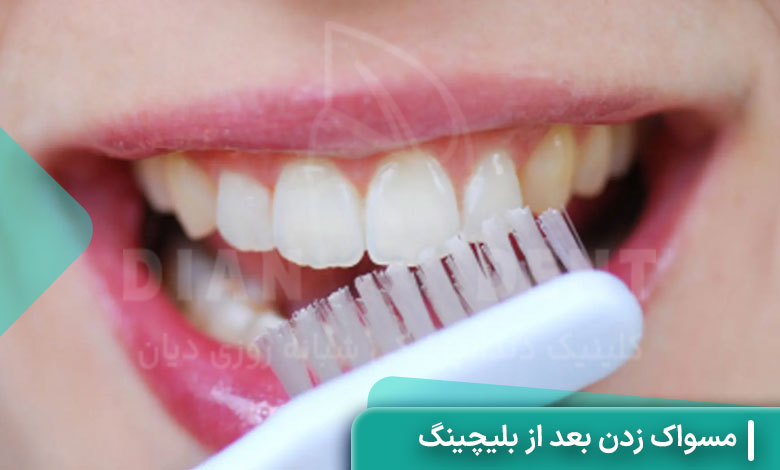 مسواک زدن بعد از بلیچینگ
