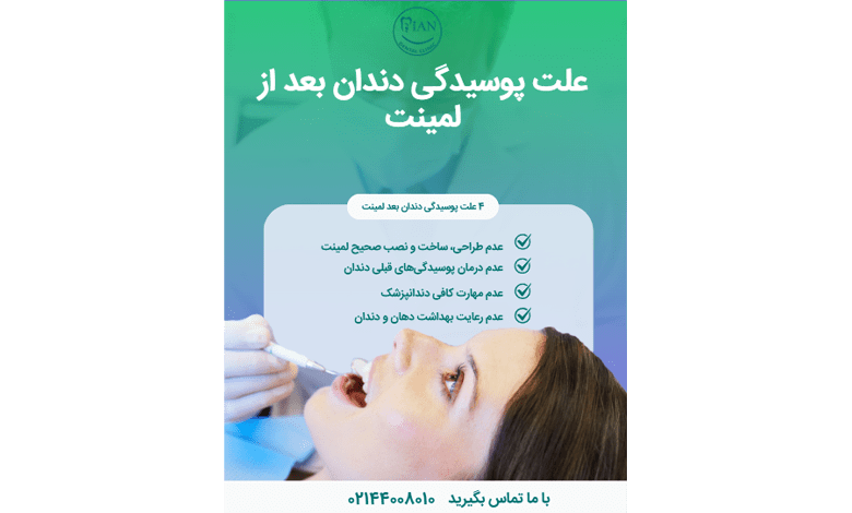 آیا لمینت باعث پوسیدگی دندان می شود