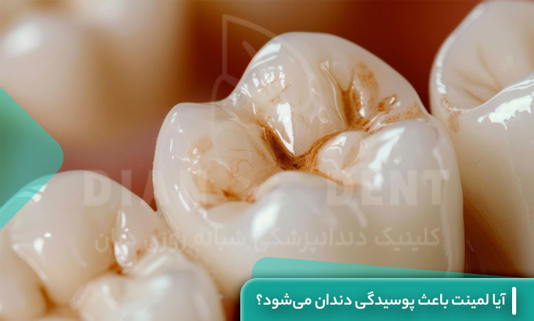 آیا لمینت باعث پوسیدگی دندان میشود؟