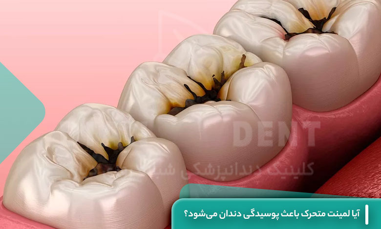 آیا لمینت متحرک باعث پوسیدگی دندان میشود؟