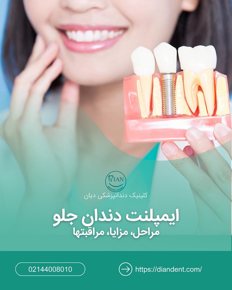 ایمپلنت دندان جلو