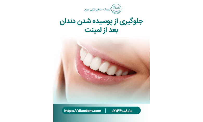 راهکارهای پیشگیری از پوسیدگی دندان بعد از لمینت