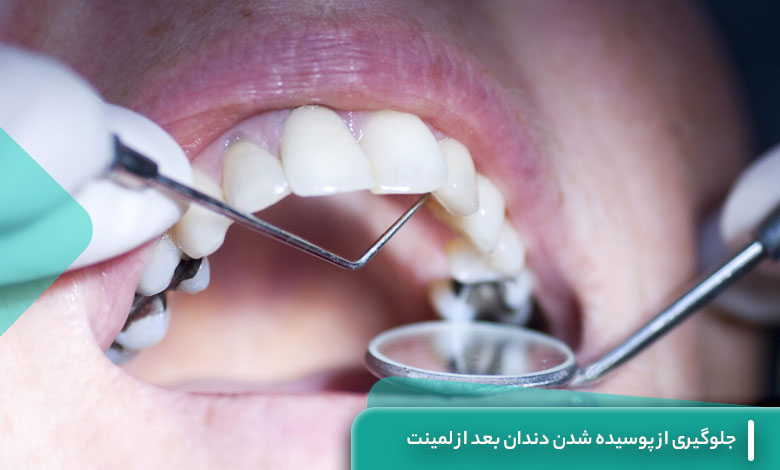برای جلوگیری از پوسیده شدن دندان بعد از لمینت چه باید کرد؟