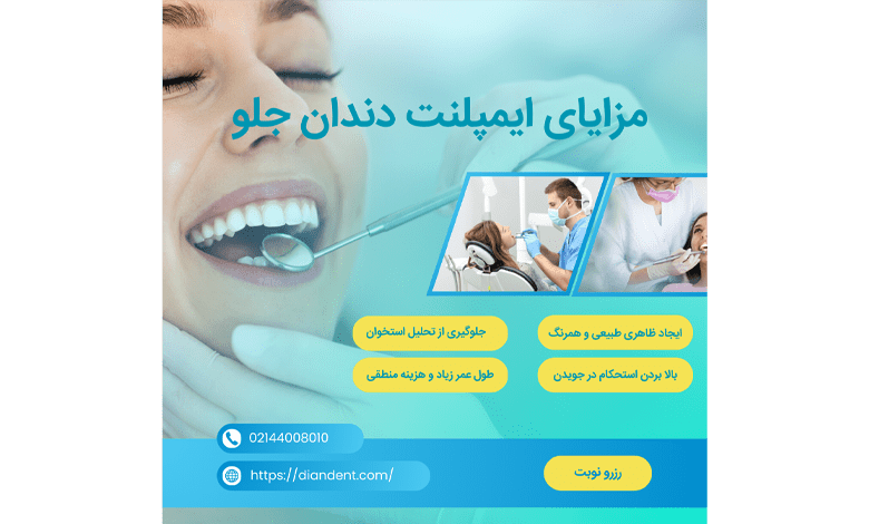 مزایای ایمپلنت دندان جلو