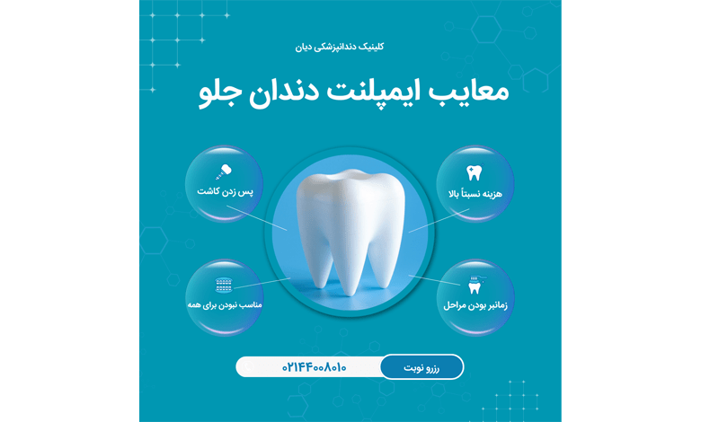 معایب ایمپلنت دندان جلو