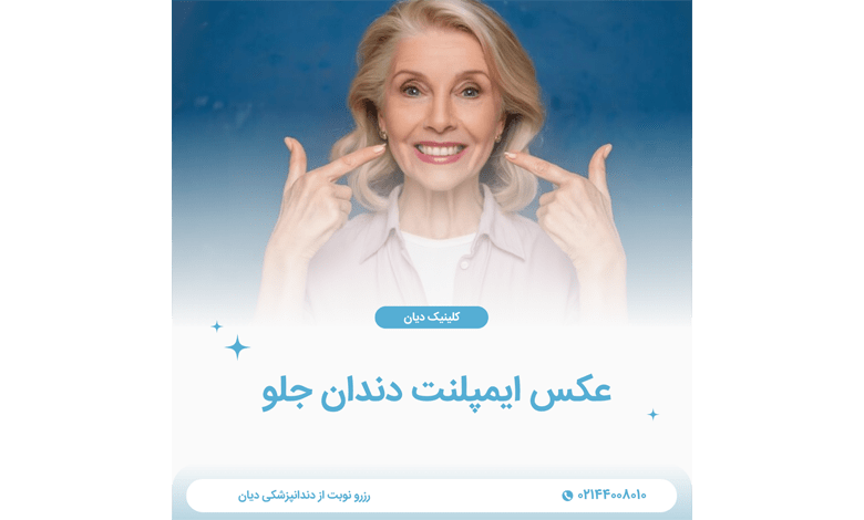 عکس ایمپلنت دندان قبل و بعد