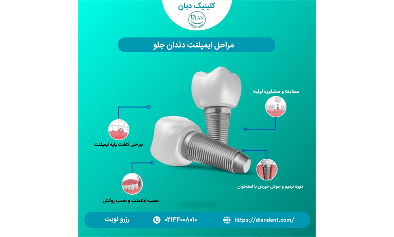 مراحل ایمپلنت دندان جلو