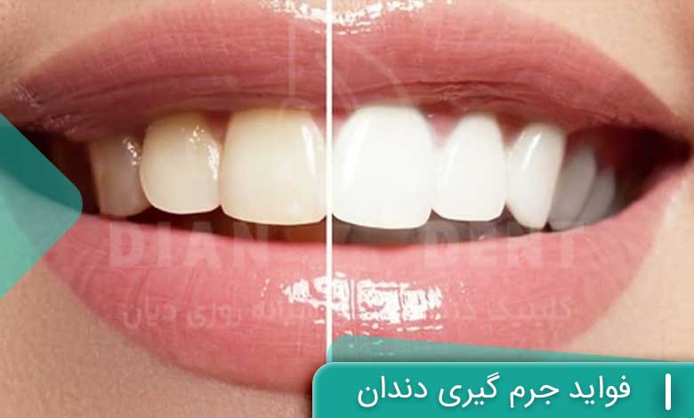 فواید جرم گیری دندان