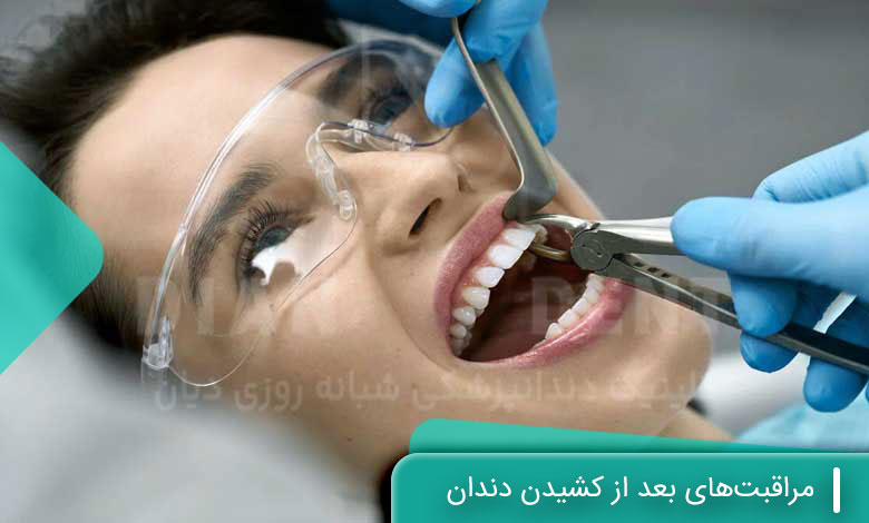 مراقبتهای بعد از کشیدن دندان