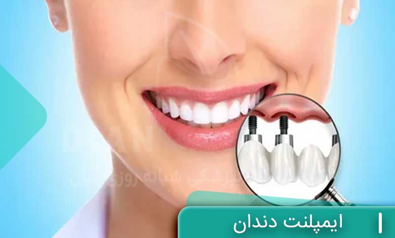 ایمپلنت دندان