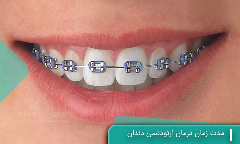 مدت زمان درمان ارتودنسی دندان