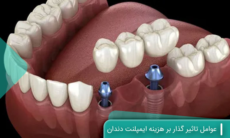 عوامل تاثیر گذار بر هزینه ایمپلنت دندان