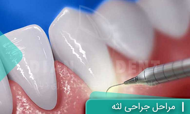 مراحل جراحی لثه