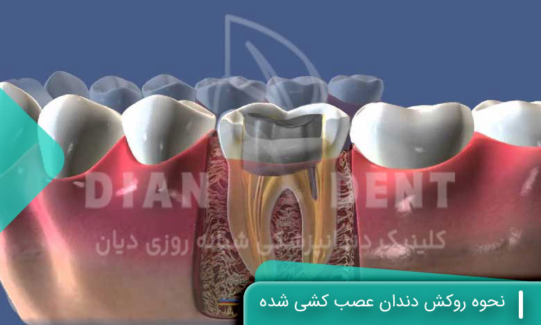 نحوه روکش دندان عصب کشی شده
