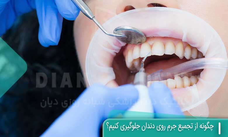 چگونه از تجمع جرم روی دندان جلوگیری کنیم؟