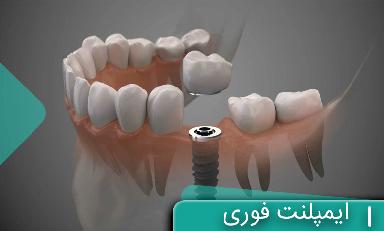  ایمپلنت فوری