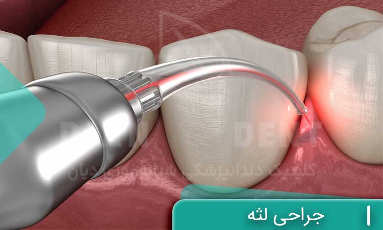 جراحی لثه