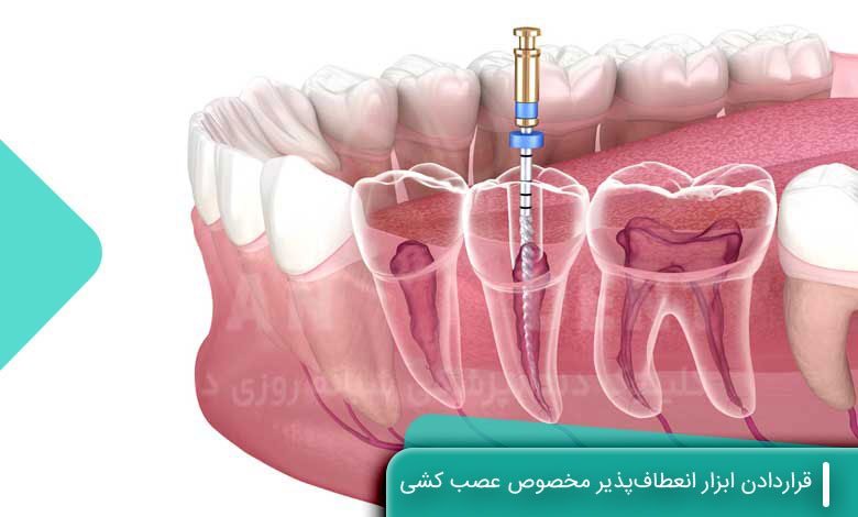 قراردادن ابزار انعطافپذیر مخصوص عصب کشی