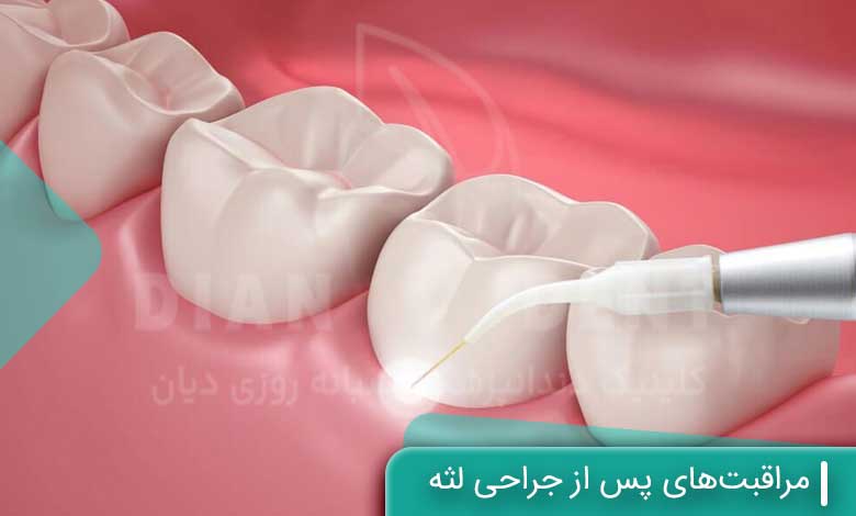 مراقبت‌های پس از جراحی لثه