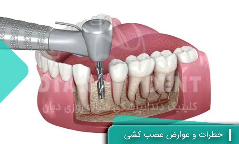 خطرات و عوارض عصب کشی