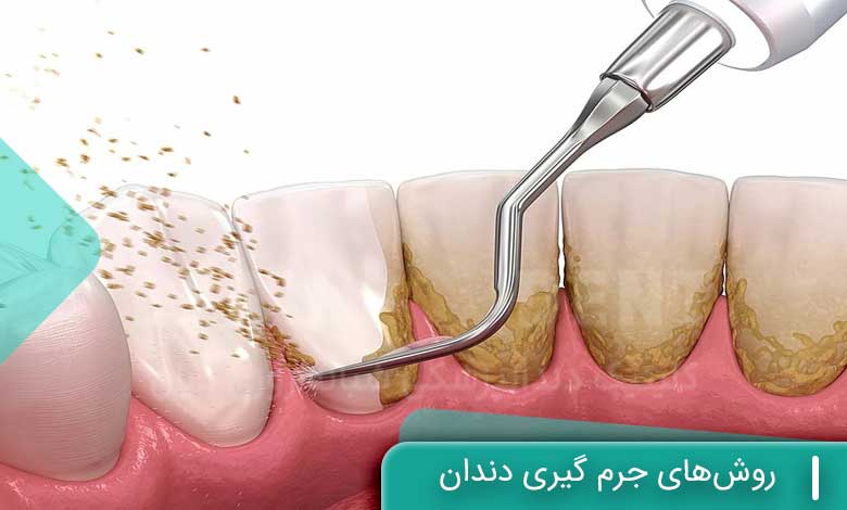 روش‌های جرم گیری دندان