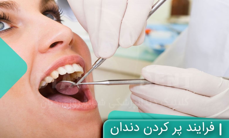 فرایند پر کردن دندان