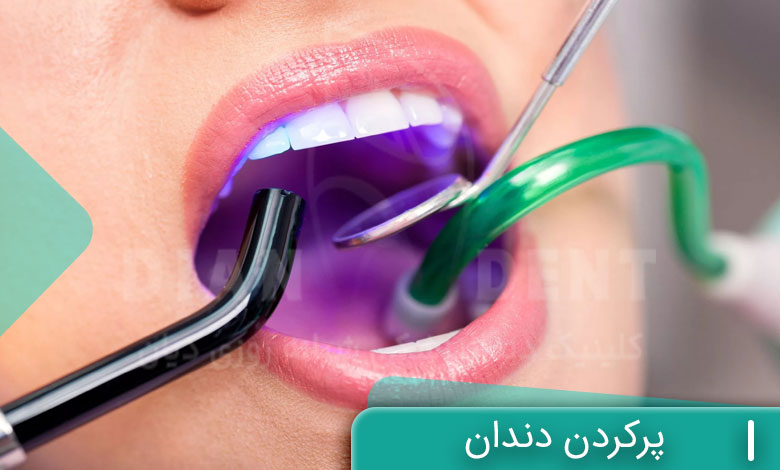پر کردن دندان
