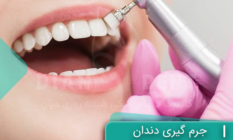 جرم گیری دندان