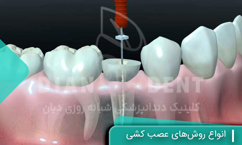 انواع روشهای عصب کشی