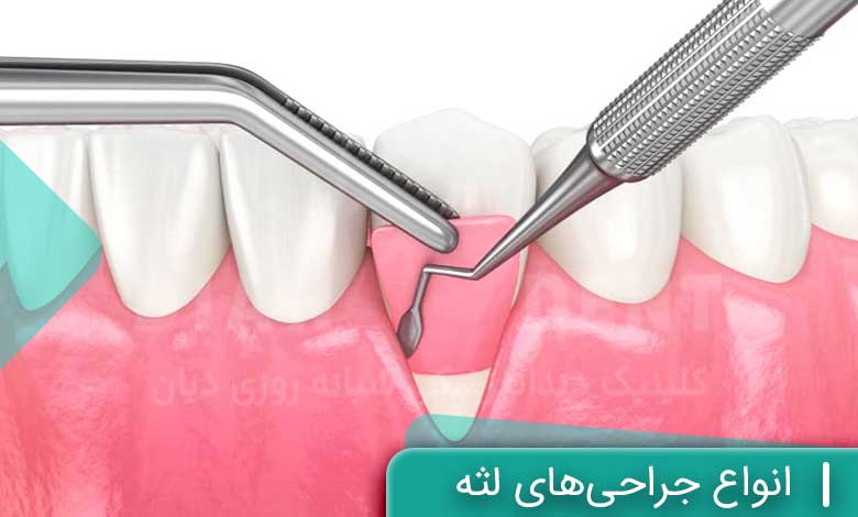 انواع جراحی‌های لثه