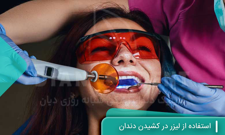 استفاده از لیزر در کشیدن دندان