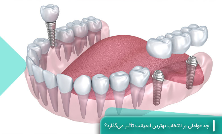  چه عواملی بر انتخاب بهترین ایمپلنت تأثیر می‌گذارد؟