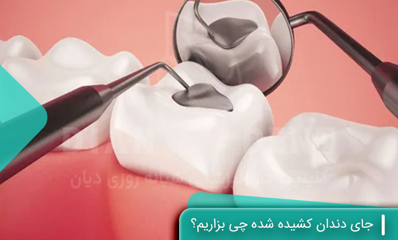 جای دندان کشیده شده چی بزاریم؟