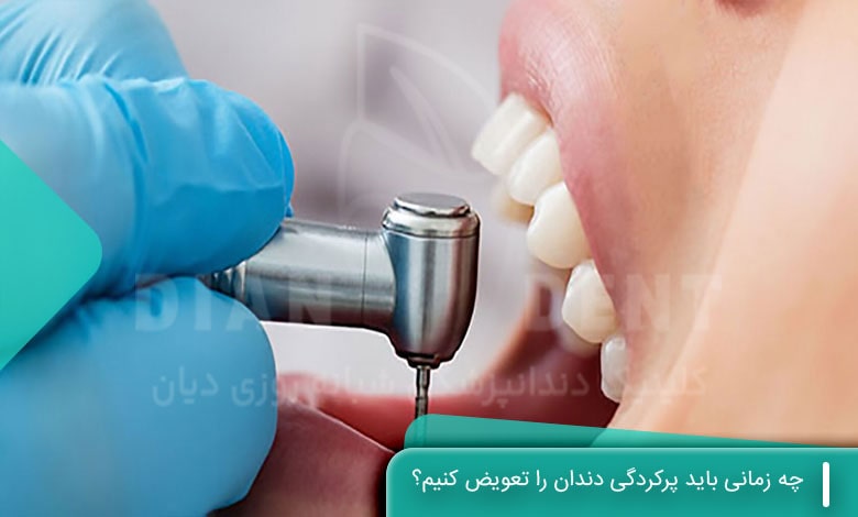 چه زمانی باید پرکردگی دندان را تعویض کنیم؟