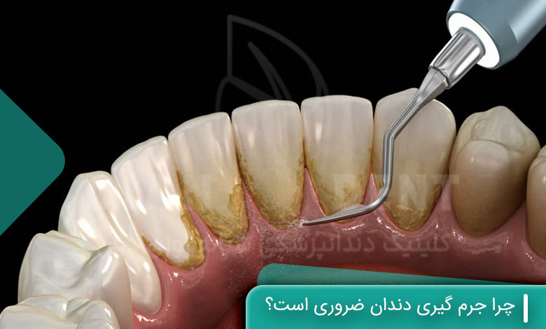  چرا جرم گیری دندان ضروری است