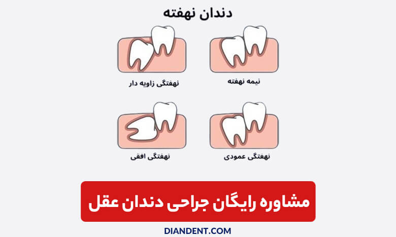 مزایا و معایب جراحی دندان عقل با لیزر