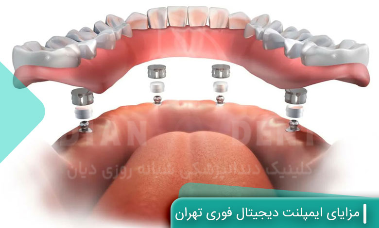 مزایای ایمپلنت دیجیتال فوری تهران