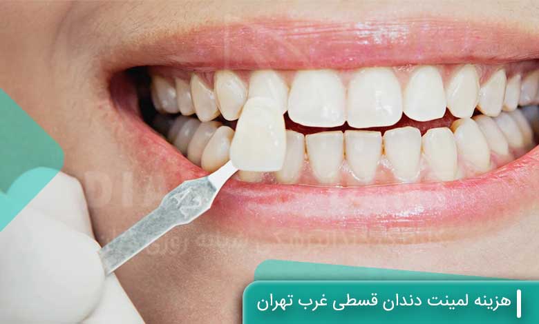 هزینه لمینت دندان قسطی غرب تهران