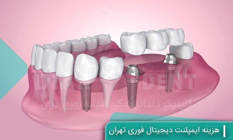 هزینه ایمپلنت دیجیتال فوری تهران