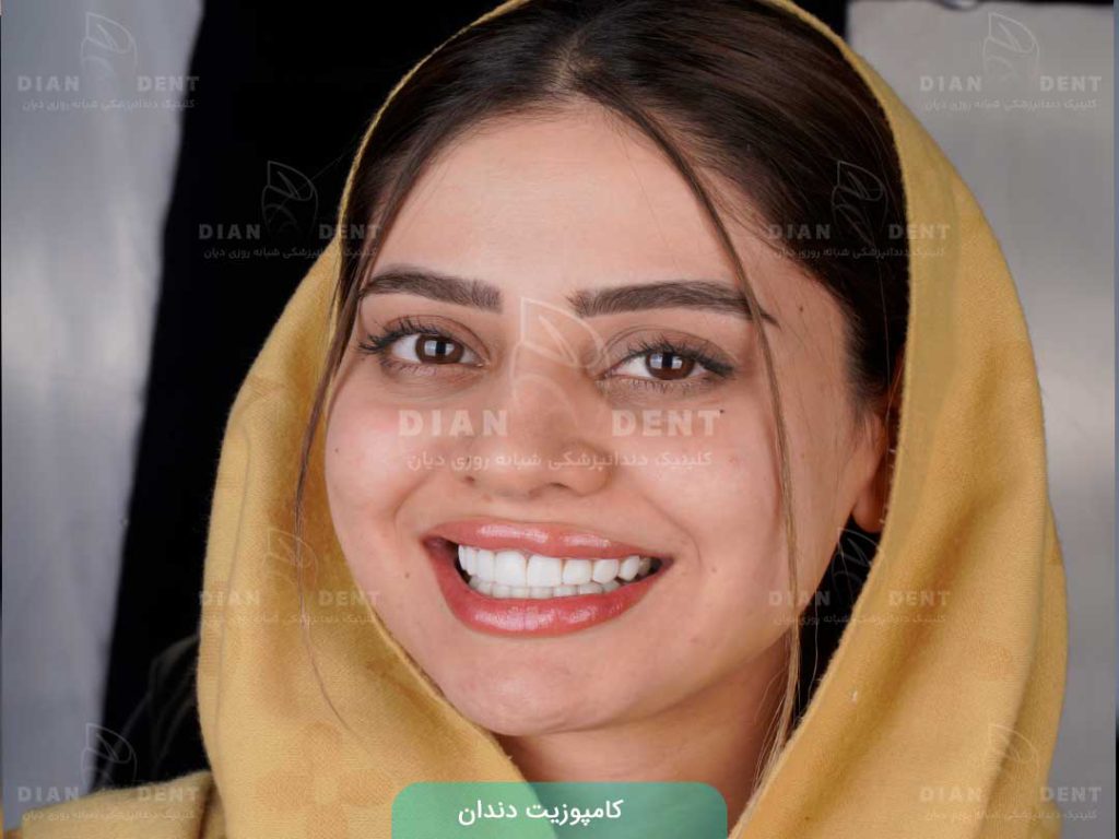 کامپوزیت دندان 8