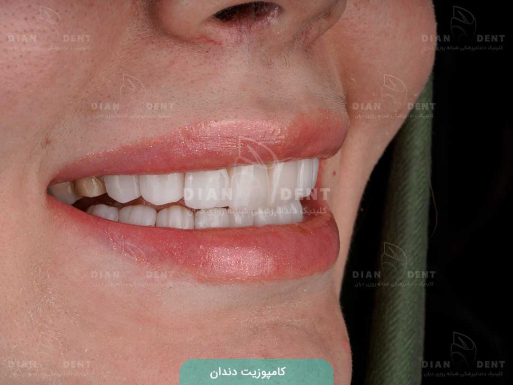کامپوزیت دندان 1