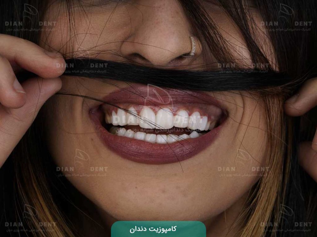 کامپوزیت دندان 2