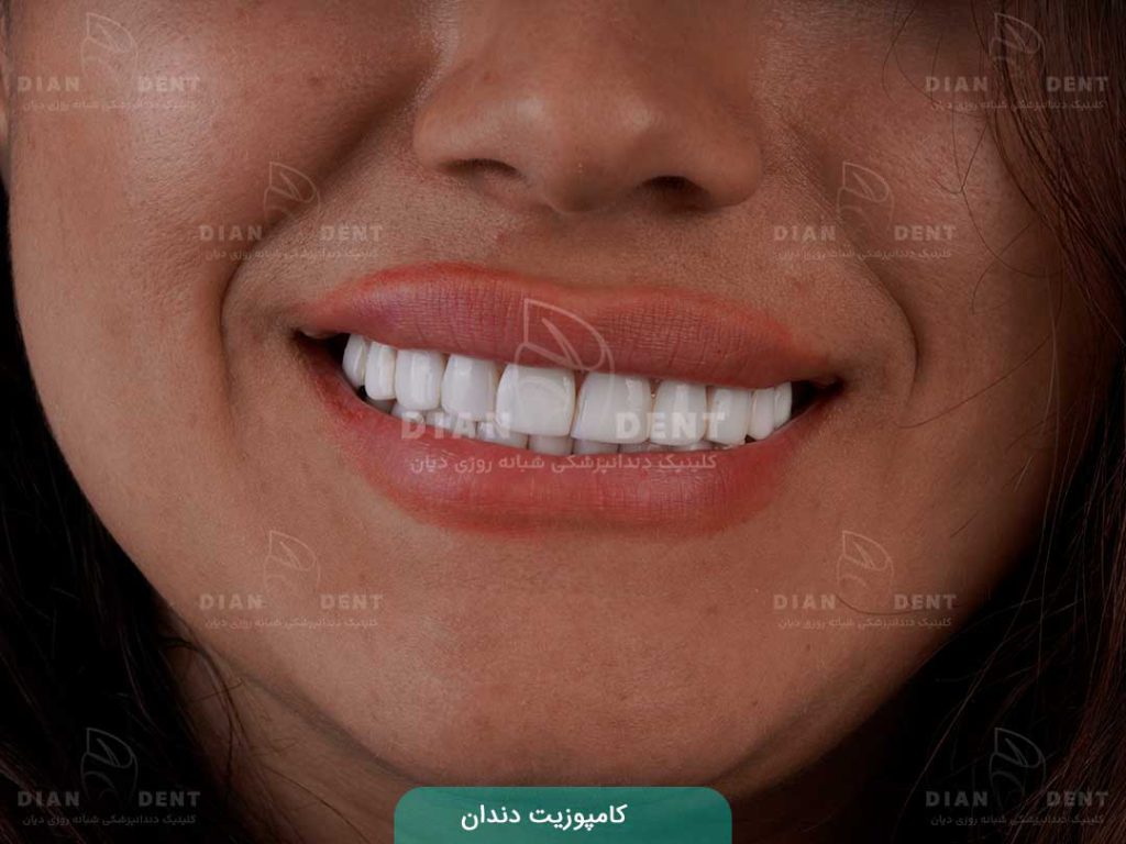 کامپوزیت دندان 3
