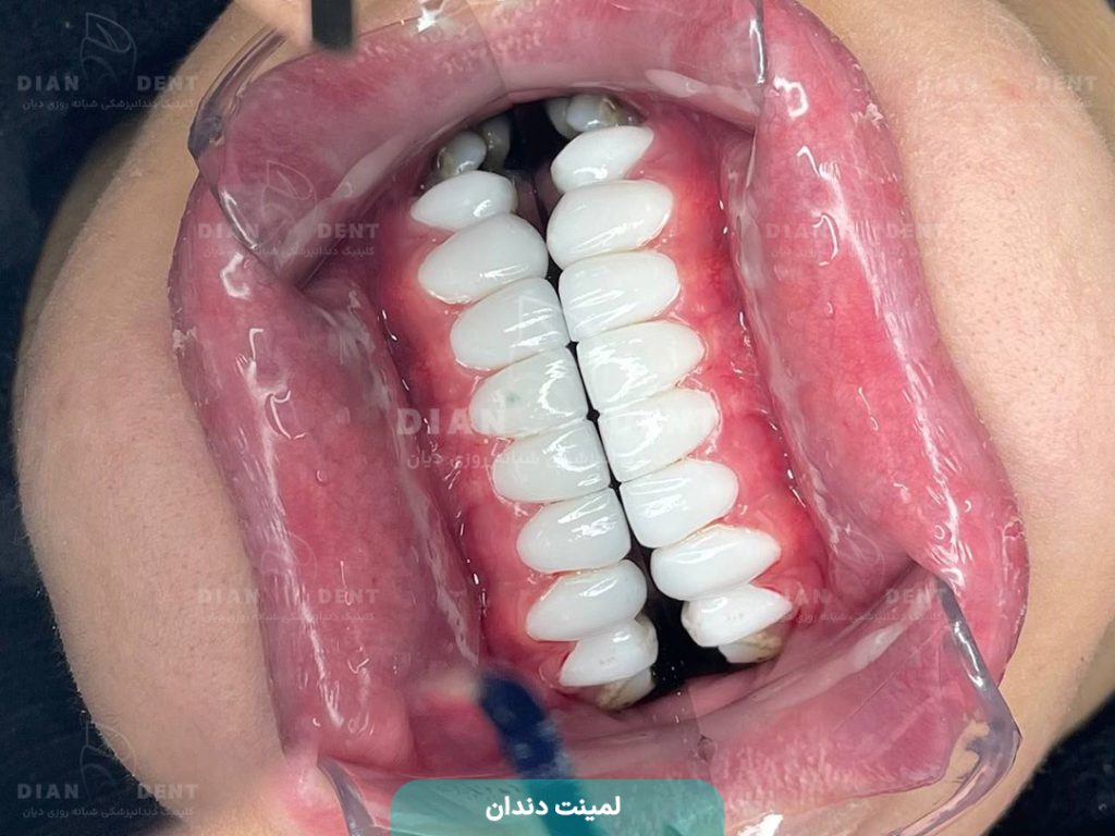 نمونه کار لمینت