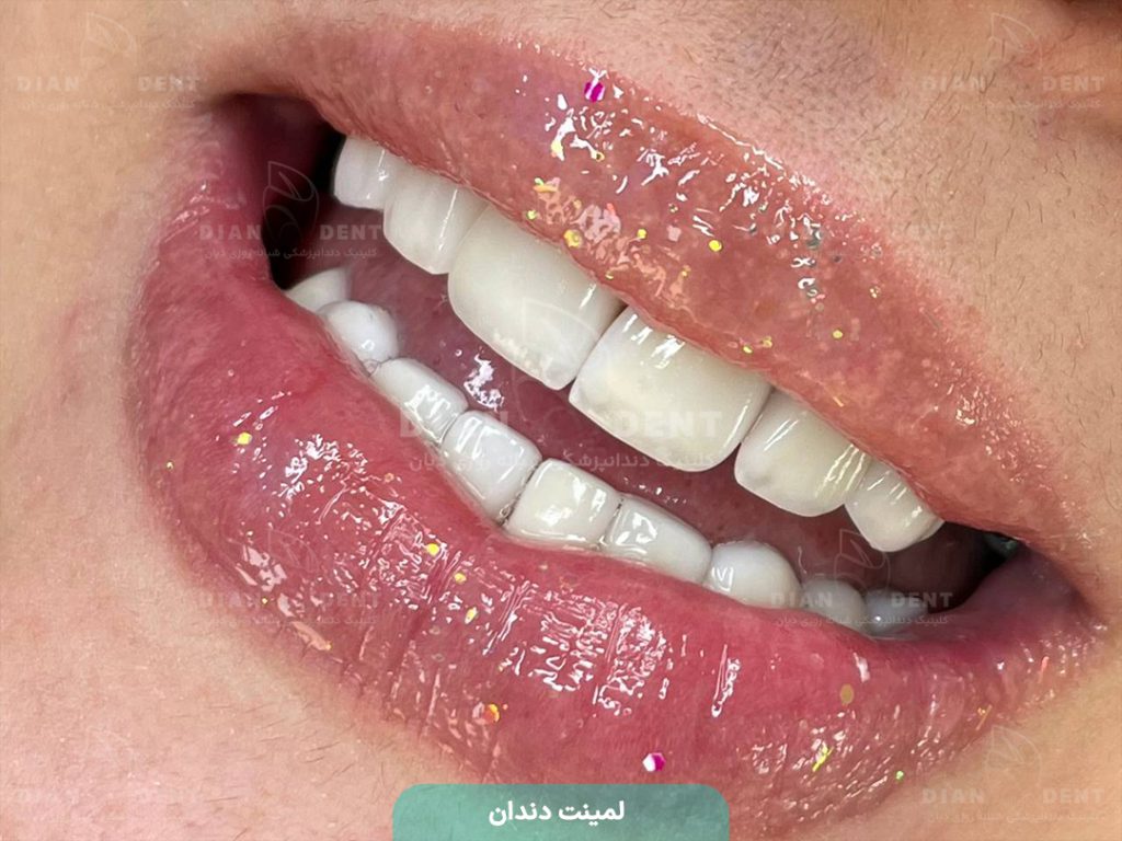 نمونه کار لمینت6