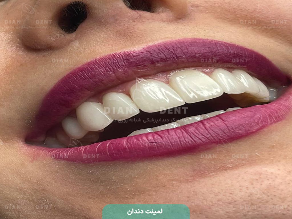 نمونه کار لمینت 1