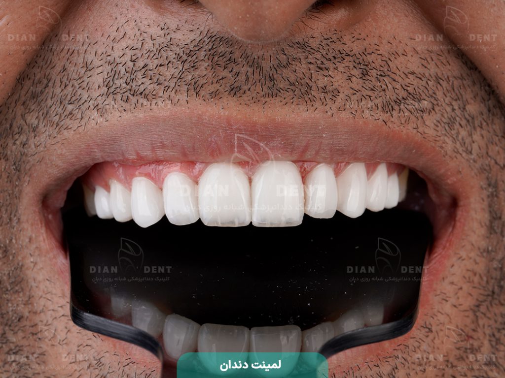 نمونه کار لمینت 2