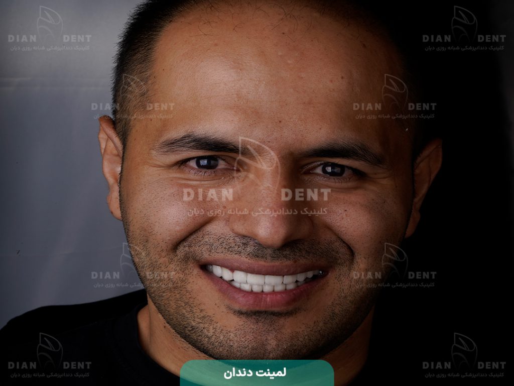 نمونه کار لمینت 3