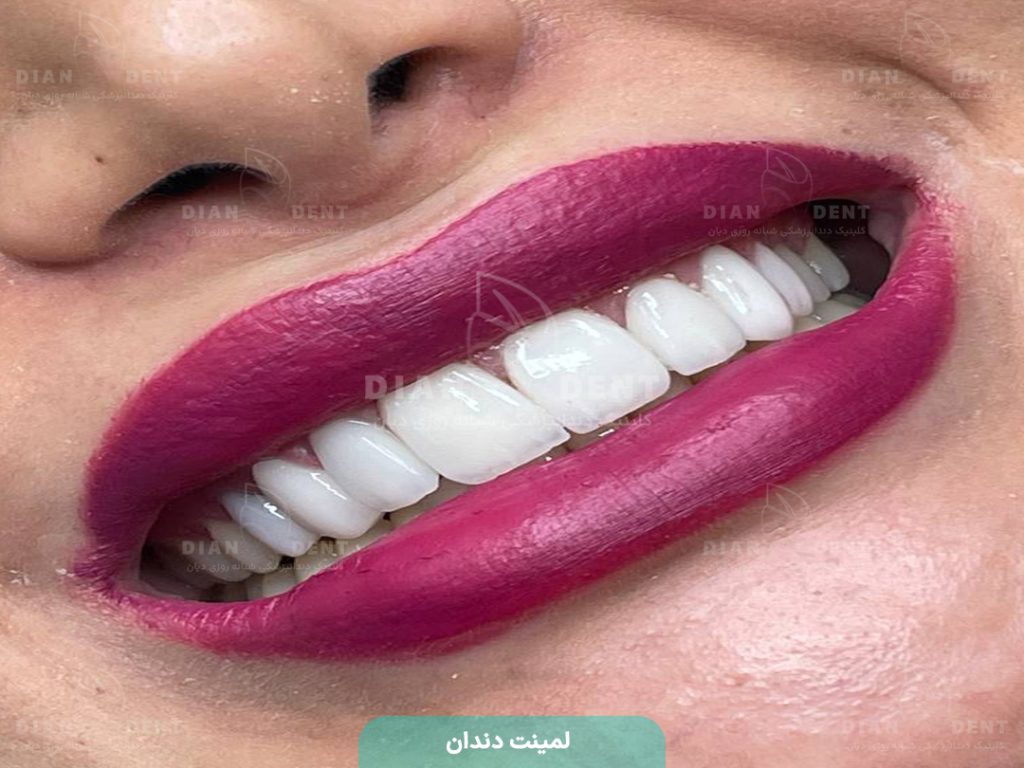 نمونه کار لمینت 4