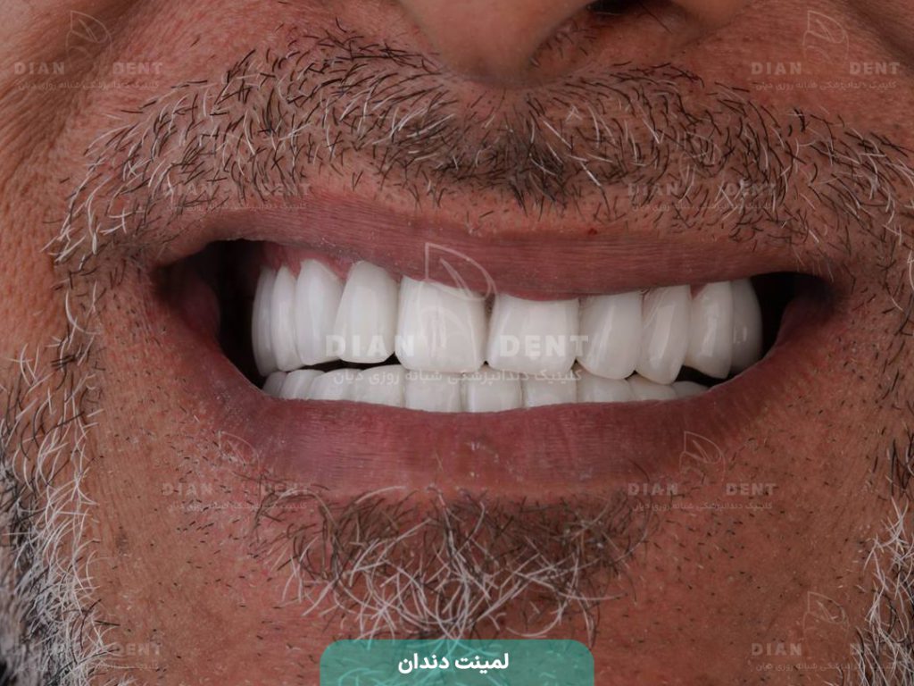 نمونه کار لمینت5